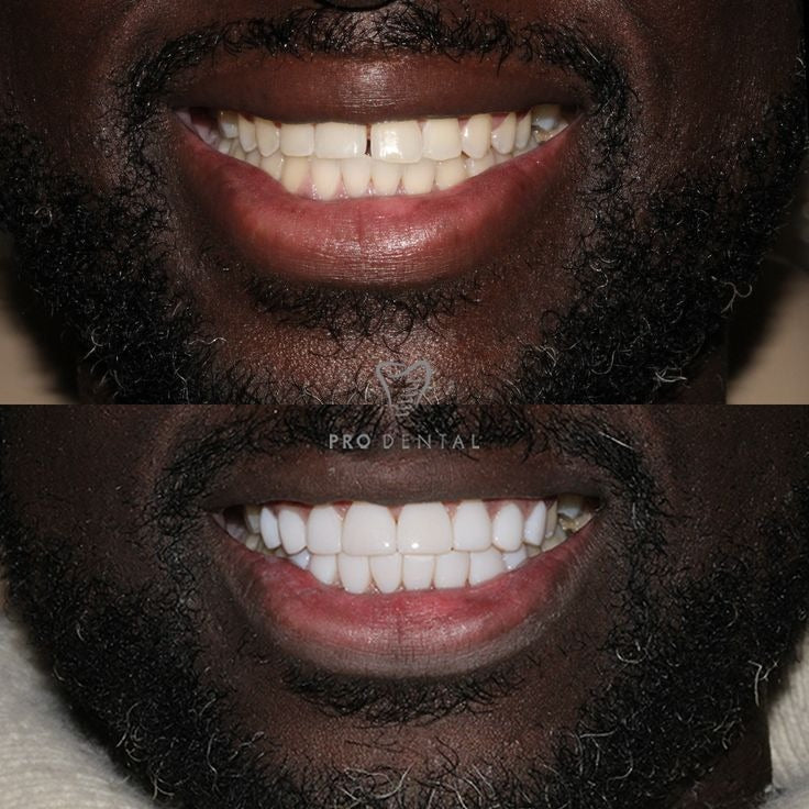 Denzen™ – Le Secret D'un Sourire Lumineux Et Confiant